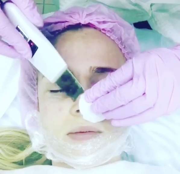 Косметологии Депиляция