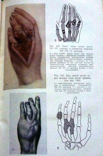 Продам книгу "Хирургия заболеваний и повреждений кисти" 1975 в Юрге фото 3