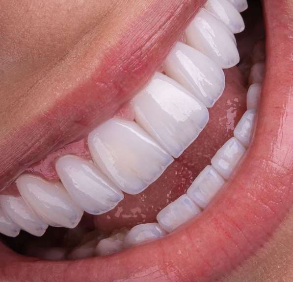 Имплантация