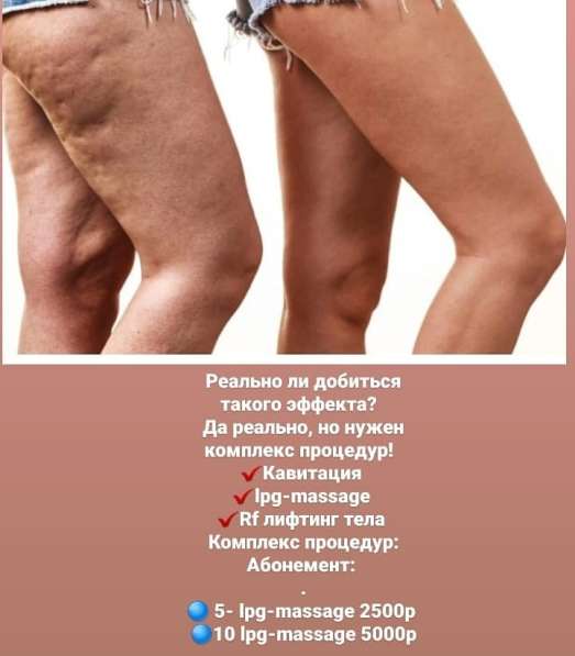 Lpg massage в Яблоновском фото 3