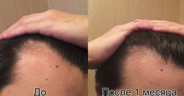 Решение проблемы выпадения волос, активация роста волос в Волгограде фото 3