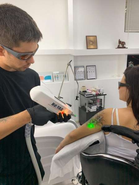 Удалить тату в Москве фото 5